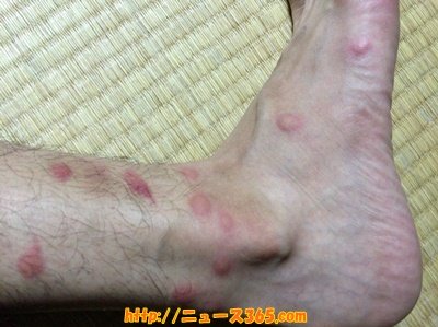 ノミ に 刺され た 跡